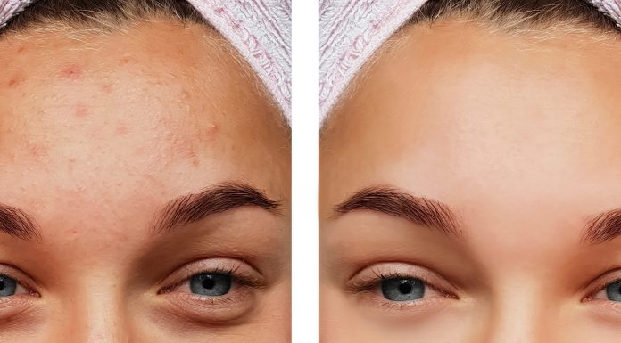 Ten leciutki krem na noc wymazuje krostki i zaskórniki jak gumka. Idealny na wiosnę