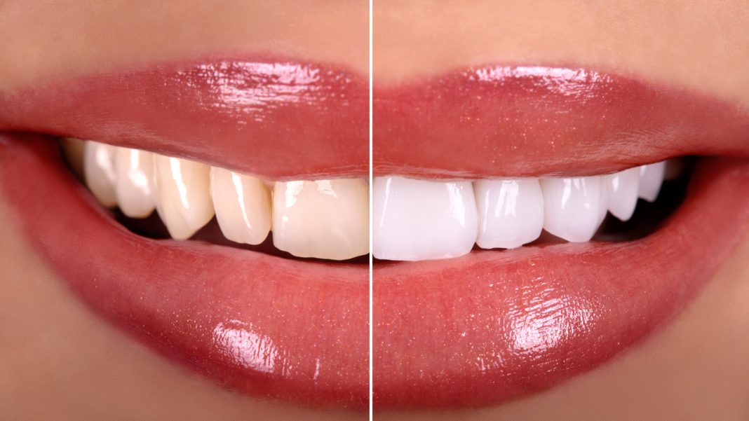 Czarny płyn z węglem rozjaśnia szkliwo i chroni przed przebarwieniami. Duża butla za mniej niż 14 zł