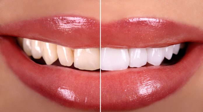 Czarny płyn z węglem rozjaśnia szkliwo i chroni przed przebarwieniami. Duża butla za mniej niż 14 zł