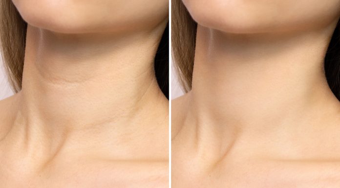 Odbudowuje utraconą gęstość skóry, szybko odmłodzi szyję. Z nim pozbędziesz się „obręczy Wenus”