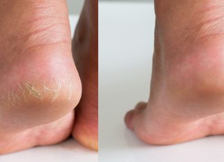 Tanie płatki złuszczające uratują zniszczone pięty. Będą ultragładkie i miękkie