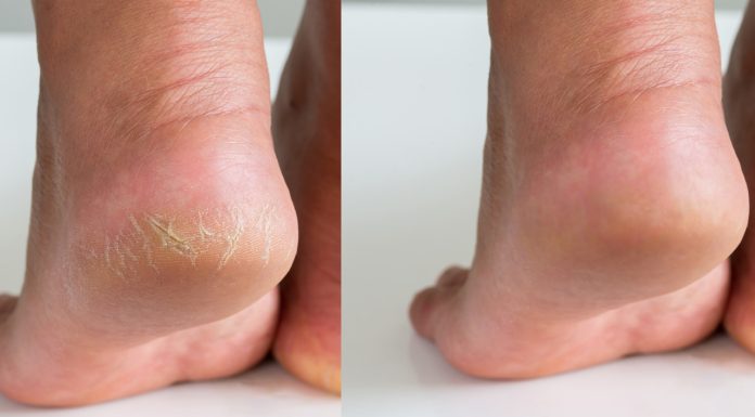 Tanie płatki złuszczające uratują zniszczone pięty. Będą ultragładkie i miękkie