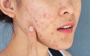 Nałóż papkę na 15 minut. Przebarwienia znikną w mig