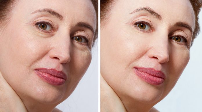 Ten hialuronowy koktajl „wypycha” skórę ku górze. To najlepszy wypełniacz zmarszczek