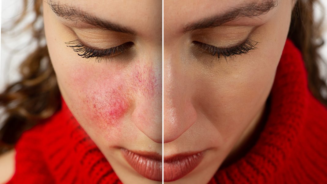 Ten krem pokocha cera naczynkowa. To killer