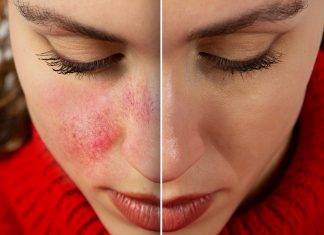 Ten krem pokocha cera naczynkowa. To killer „pajączków”, błyskawicznie wycisza rumień