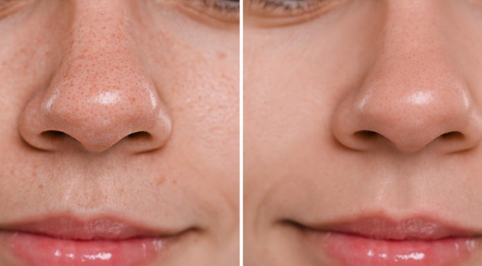 Ten niepozorny koncentrat to pogromca wągrów na nosie. Działa na nie jak ścierająca gumka. Magik!