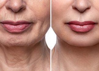 Kremowy wypełniacz na bruzdy nosowo-wargowe. Działa jak liftingująca różdżka