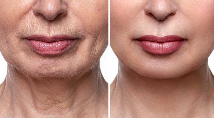 Kremowy wypełniacz na bruzdy nosowo-wargowe. Działa jak liftingująca różdżka