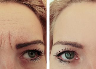 Ten wypełniacz już w kilka tygodni zmniejszy widoczność lwiej zmarszczki. „Prasuje” skórę od pierwszego użycia