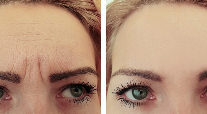 Ten wypełniacz już w kilka tygodni zmniejszy widoczność lwiej zmarszczki. „Prasuje” skórę od pierwszego użycia