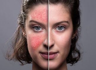 Te kremy minimalizują widoczność pajączków. Świetnie łagodzą podrażnienia