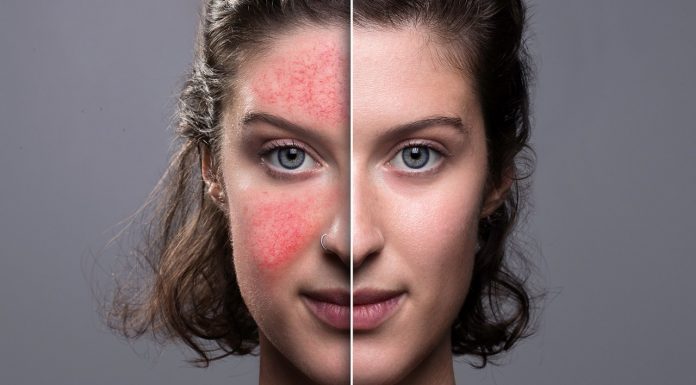 Te kremy minimalizują widoczność pajączków. Świetnie łagodzą podrażnienia