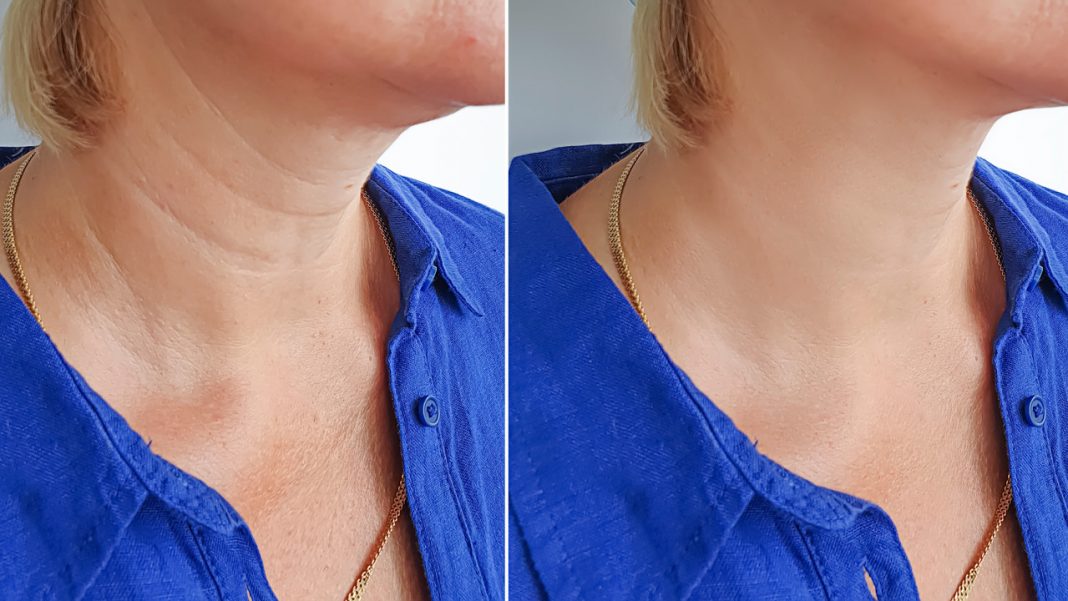 Ten kolagen w kremie sprawia, że dekolt staje się gładki jak tafla lustra. Usuwa też postarzające obręcze Wenus z szyi