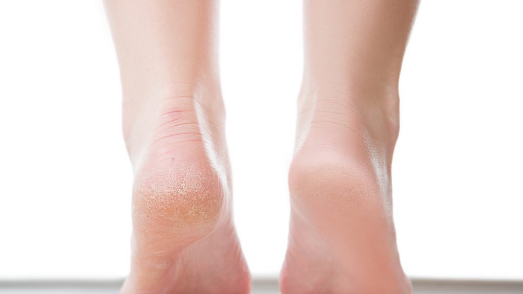 Krem-kompres to pewniak na popękane pięty. Kosztuje 15 zł, szybko przywraca gładkość