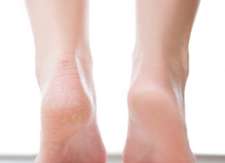 Krem-kompres to pewniak na popękane pięty. Kosztuje 15 zł, szybko przywraca gładkość