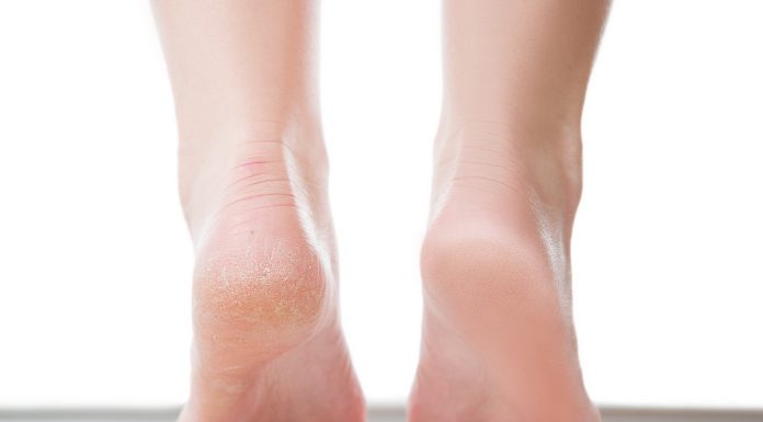 Krem-kompres to pewniak na popękane pięty. Kosztuje 15 zł, szybko przywraca gładkość
