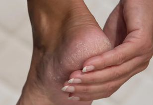 Wsmaruj w stopy po kąpieli. Będą gładkie jak u niemowlaka