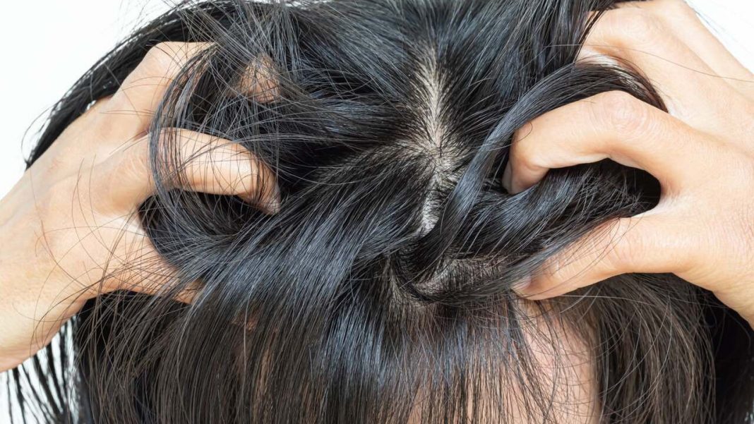 Dlaczego skóra głowy swędzi? Poznaj główne przyczyny