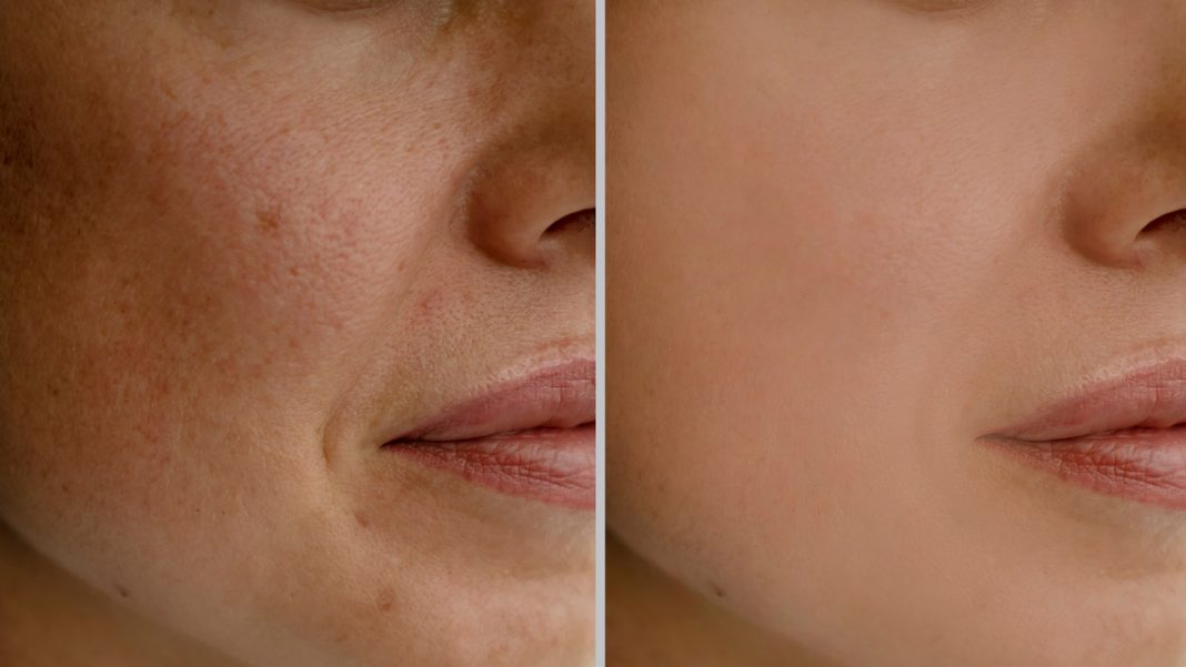 Plamy starcze na twarzy i dłoniach nie mają szans z tym kremem. Mówią o nim depigmentacyjna bomba