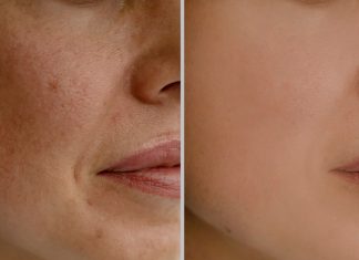 Plamy starcze na twarzy i dłoniach nie mają szans z tym kremem. Mówią o nim depigmentacyjna bomba