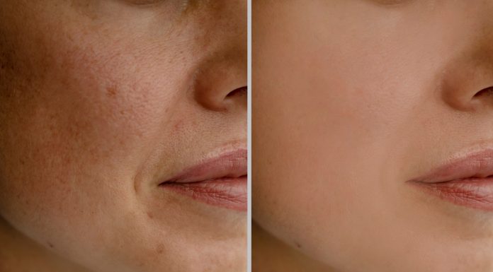 Plamy starcze na twarzy i dłoniach nie mają szans z tym kremem. Mówią o nim depigmentacyjna bomba