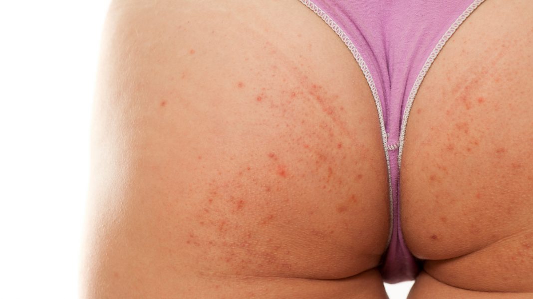 Ten peeling do ciała to prawdziwy zdzierak! Pożegnaj krostki z pupy, pleców i ramion