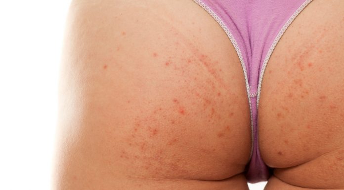 Ten peeling do ciała to prawdziwy zdzierak! Pożegnaj krostki z pupy, pleców i ramion