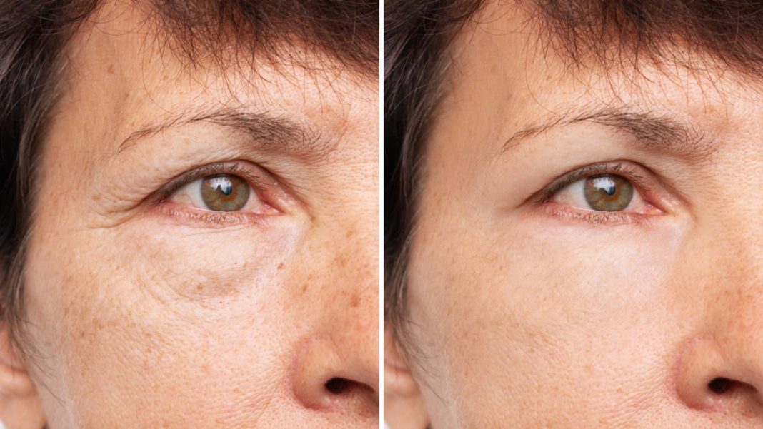 Żaden krem pod oczy nie da takiego efektu. Ten masażer redukuje obrzęki