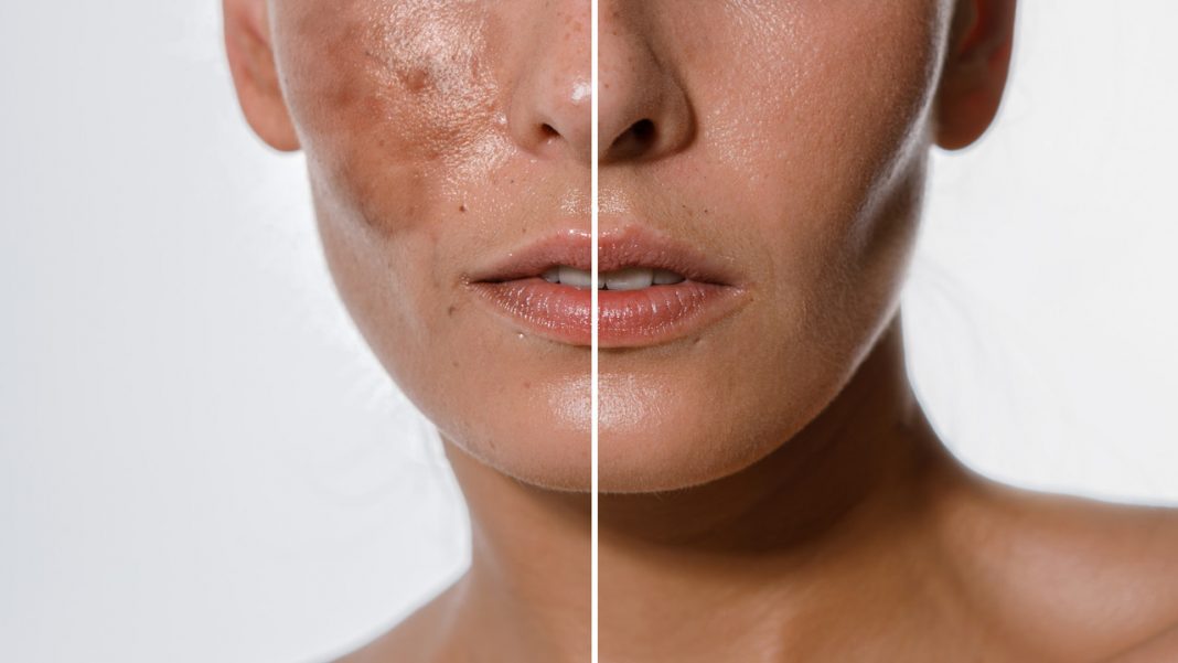 Mocny krem do skóry z hiperpigmentacją. Działa jak rozjaśniająca polerka na ciemne plamy. Magik!