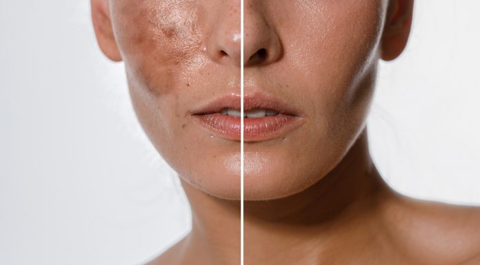 Mocny krem do skóry z hiperpigmentacją. Działa jak rozjaśniająca polerka na ciemne plamy. Magik!