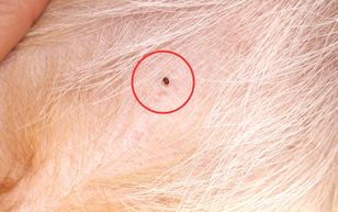 Przypominają pieprzyki. Pojawienie się na ciele to zły znak