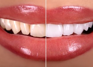 Jak pozbyć się żółtego osadu na zębach? Skuteczne metody