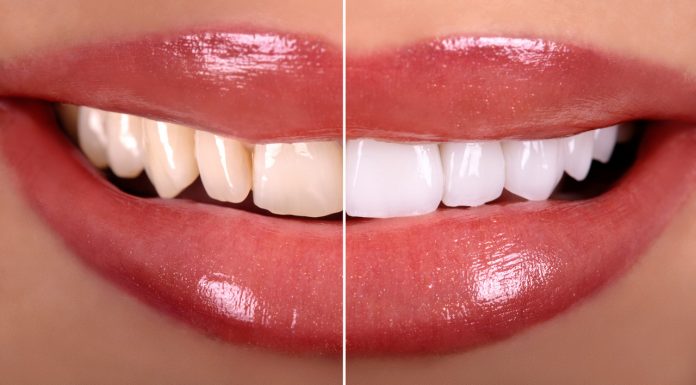 Jak pozbyć się żółtego osadu na zębach? Skuteczne metody