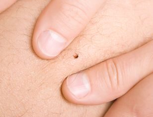 Wetrzyj w kostki. Kleszcze nawet się nie zbliżą