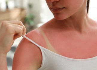 Skóra piecze po opalaniu? Wypróbuj domowe sposoby na oparzenia słoneczne