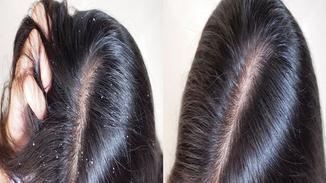 W mig rozprawi się z łupieżem, usunie z włosów nadmiar sebum. Ten szampon sprawdzi się do wszystkich typów włosów