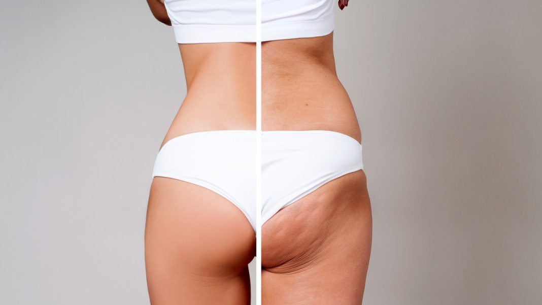 Zapomnij o kremach i zabiegach. Tylko to urządzenie jest w stanie pokonać cellulit