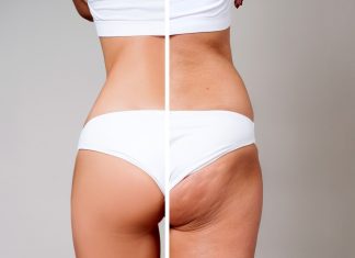 Zapomnij o kremach i zabiegach. Tylko to urządzenie jest w stanie pokonać cellulit