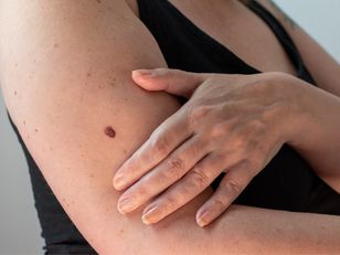 Widzisz przy pieprzyku? Tak wygląda rak