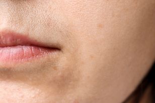 Domowe plastry na wąsik. Działają lepiej, niż te z drogerii