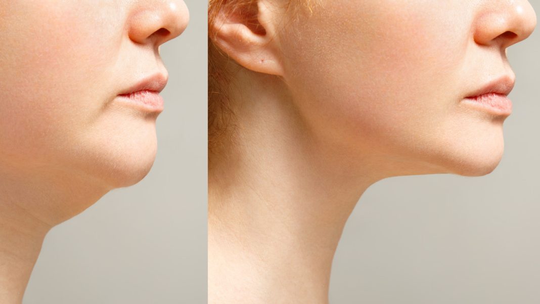 Unosi podbródek i modeluje owal twarzy.