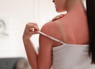 Pięć preparatów, które ukoją skórę po nadmiernym opalaniu