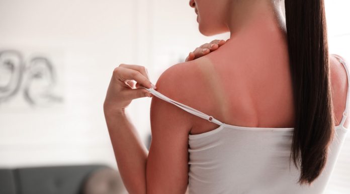 Pięć preparatów, które ukoją skórę po nadmiernym opalaniu