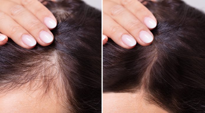 To serum kosmicznie zagęszcza włosy. Działa nawet na widoczne zakola, pokochały je 60-latki