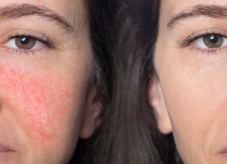 Taniutki krem do cery naczynkowej. „Wciąż do niego wracam. Skóra odzyskuje naturalny kolor”