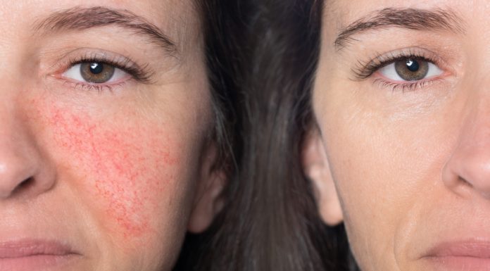 Taniutki krem do cery naczynkowej. „Wciąż do niego wracam. Skóra odzyskuje naturalny kolor”