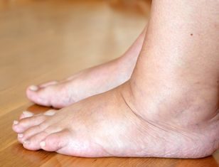 Szklanka octu wystarczy. Opuchnięte stopy będą wspomnieniem