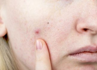 Ta tania maść z apteki to ekspresowy sposób na wypryski. Kosztuje 5 zł