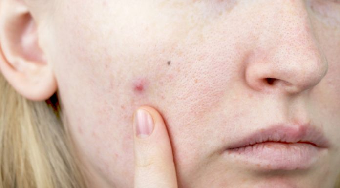 Ta tania maść z apteki to ekspresowy sposób na wypryski. Kosztuje 5 zł